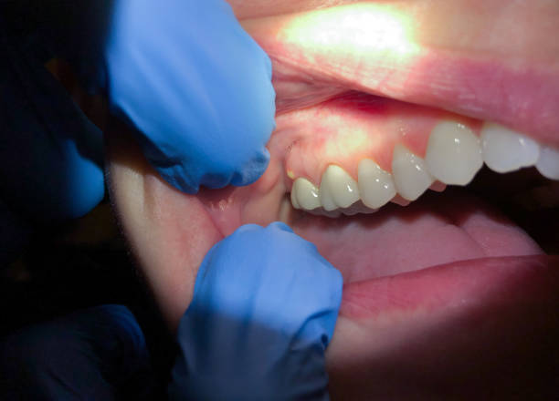 Best Emergency Dental Care for Broken or Chipped Teeth in Warren, PA